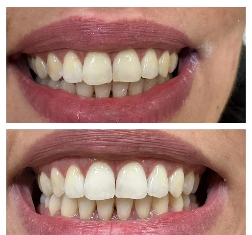 Teeth whitening, frontal view of the smile with the lips parted, showing both arches. Upper half, before treatment: the enamel tends towards yellow, particularly at the necks of the incisors and on the canines. Lower half, after treatment: the shade is lighter and more consistent from one tooth to the next.
