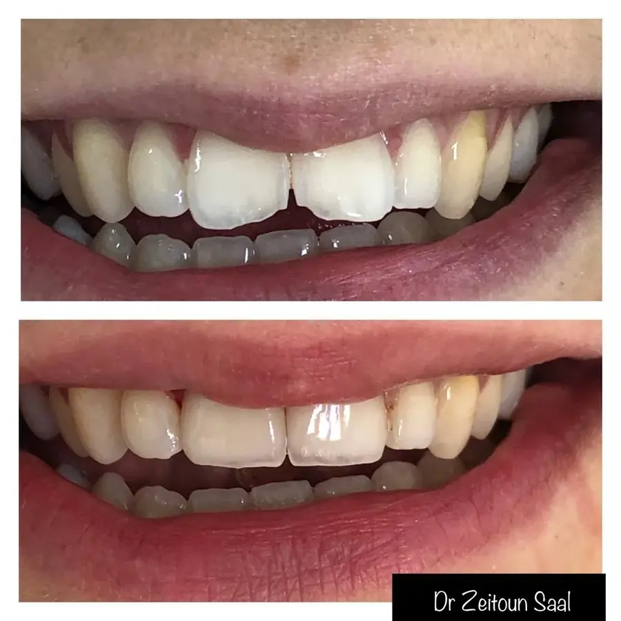 Ceramic veneers on the maxillary central incisors, smile seen in three-quarter view — composite photograph combining the situation before and the situation after.