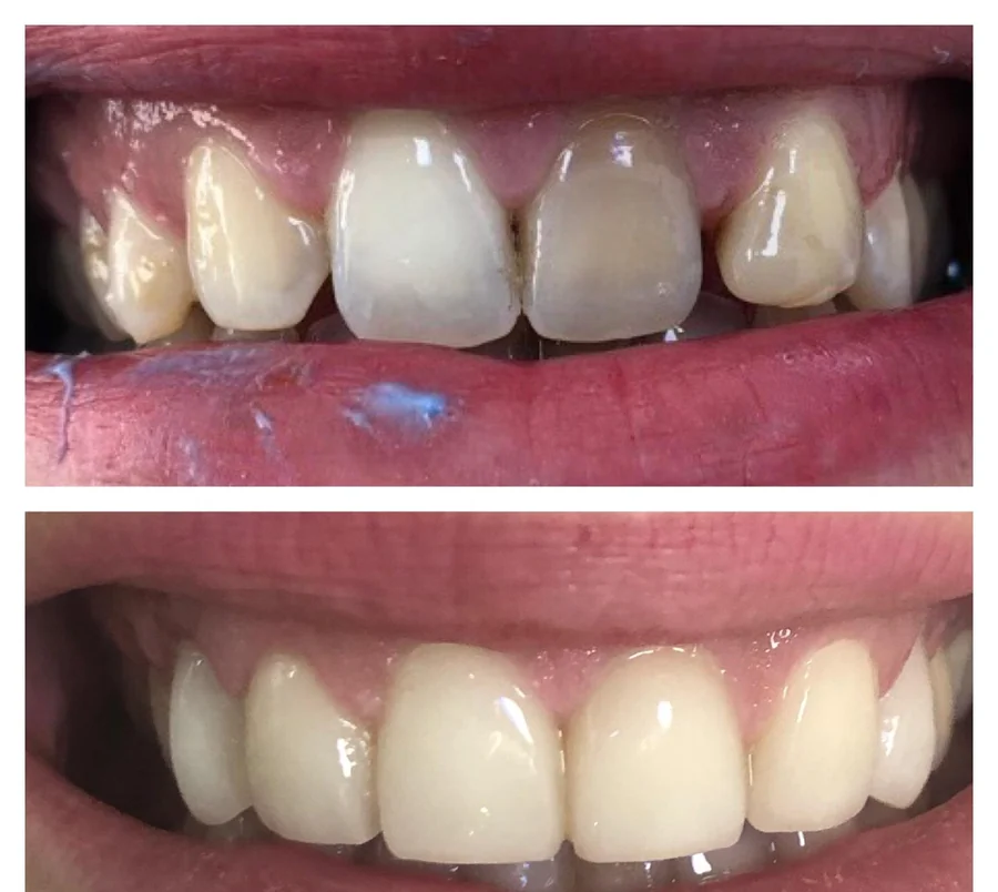 Maxillary incisors with one lateral incisor markedly darker than the neighbouring teeth, then after ceramic veneers were fitted — composite photograph combining the situation before, above, and after, below.