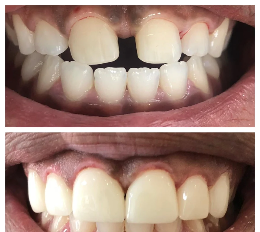 Marked gaps between the maxillary incisors, then after ceramic veneers were fitted to close them — composite photograph combining the situation before, above, and after, below.