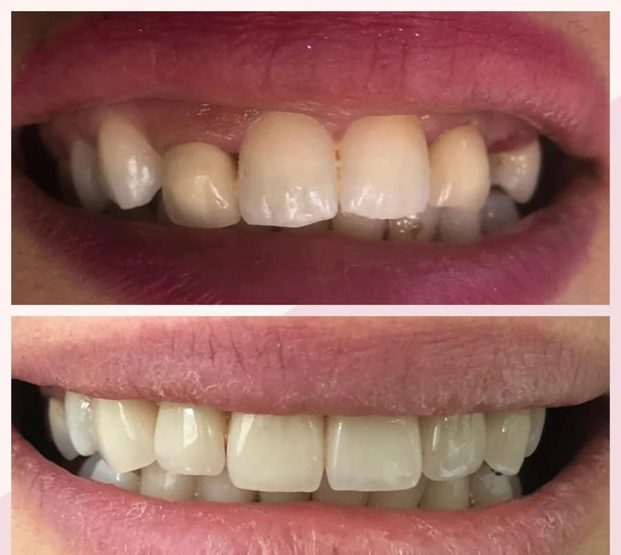 Uneven incisal edges on the maxillary incisors with an inconsistent shade, then after ceramic veneers were fitted — composite photograph combining the situation before, above, and after, below.