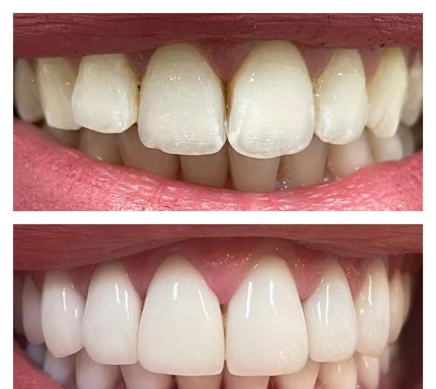 Frontal view of a smile with unevenly shaded maxillary incisors, then after ceramic veneers were fitted — composite photograph combining the situation before, above, and after, below.