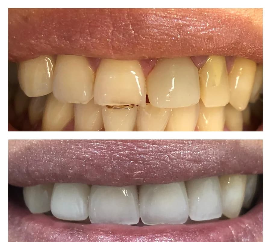 Worn and stained maxillary incisors with visible damage to one incisal edge, then after ceramic veneers were fitted — composite photograph combining the situation before, above, and after, below.