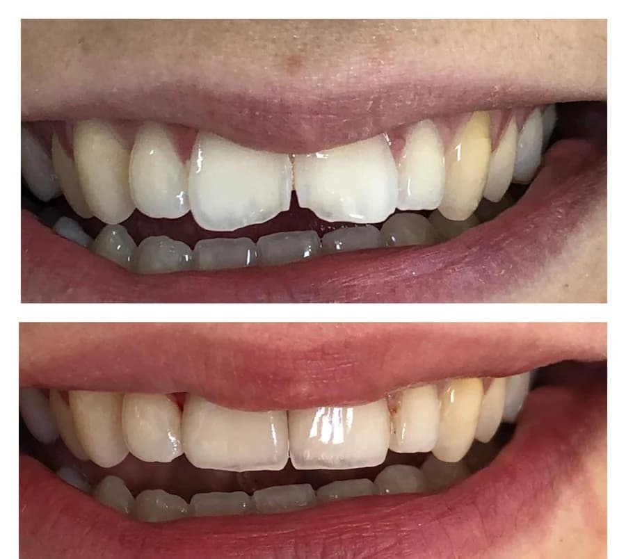 Maxillary incisors of uneven alignment and length, then after ceramic veneers were fitted — composite photograph combining the situation before, above, and after, below.
