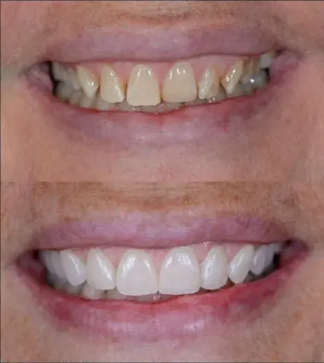 Smile makeover, frontal view of the maxillary anterior region — composite photograph combining the situation before and the situation after.