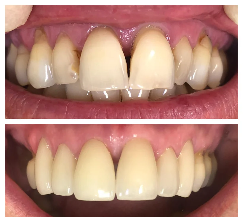Réhabilitation du sourire, vue rapprochée du secteur antérieur. Moitié haute, avant traitement : les collets sont dégagés, les dents apparaissent longues et de teintes inégales. Moitié basse, après traitement : les proportions et la teinte des dents antérieures sont régulières.