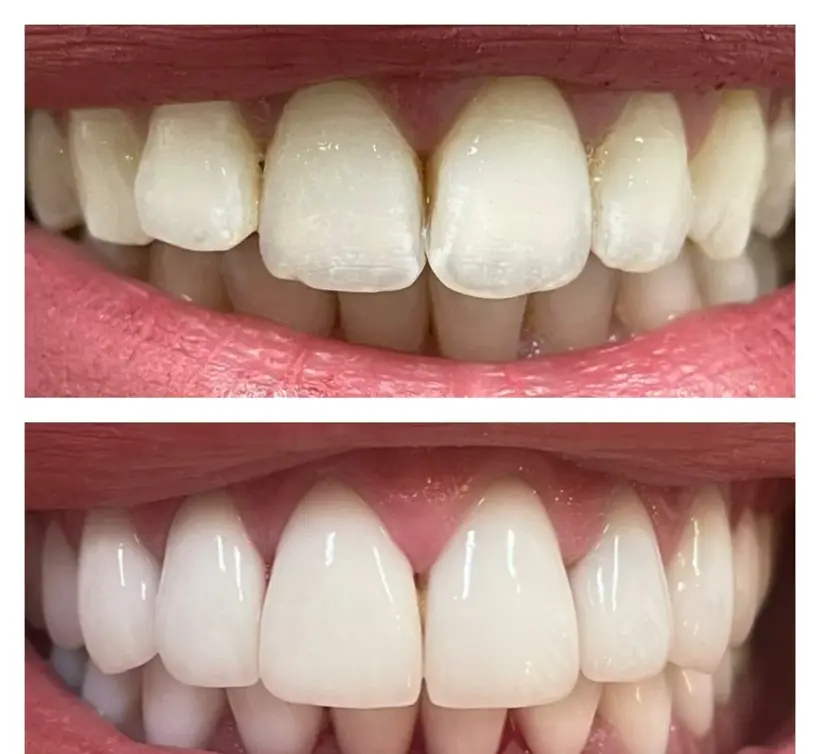 Smile makeover, close-up of the anterior region with the lips retracted — composite photograph combining the situation before and the situation after.