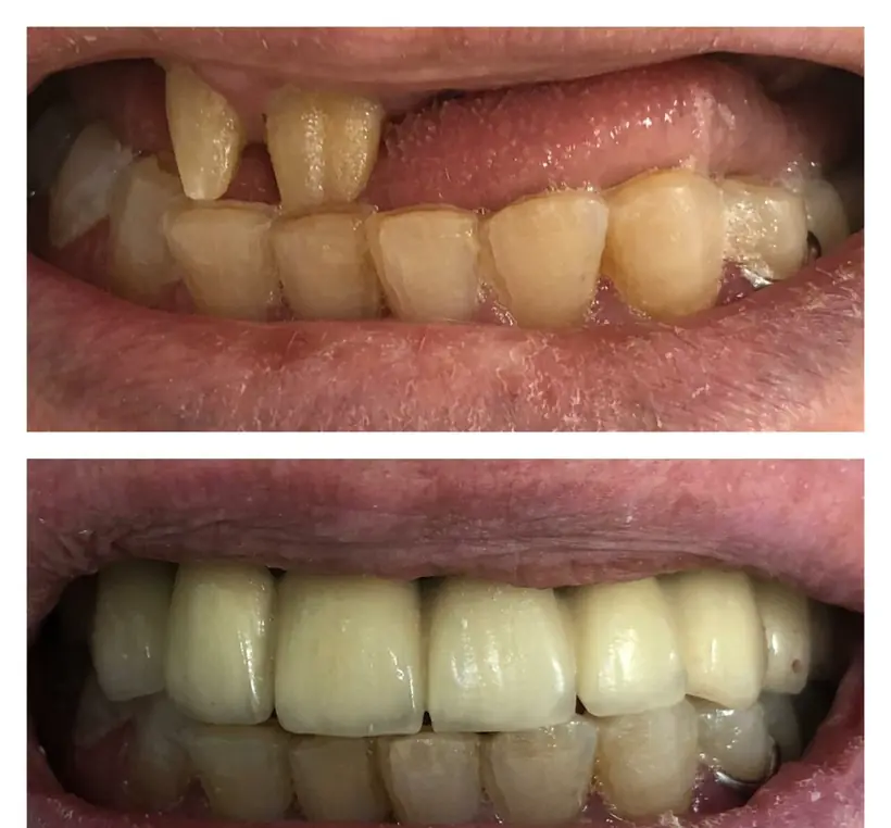 Smile makeover, lateral view: an edentulous gap in the upper half of the image, a complete arch in the lower half — composite photograph combining the situation before and the situation after.