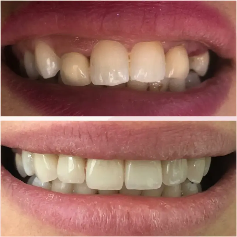 Smile makeover, maxillary incisors and canines seen from the front — composite photograph combining the situation before and the situation after.