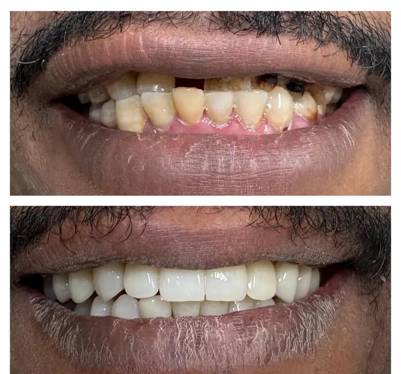Smile makeover, frontal view of both arches with the lips parted. Upper half, before treatment: the teeth are worn, uneven in shade and irregular at the edges, with extensive dark areas in the lateral region. Lower half, after reconstruction of both arches: the crowns show regular shapes and an even shade.