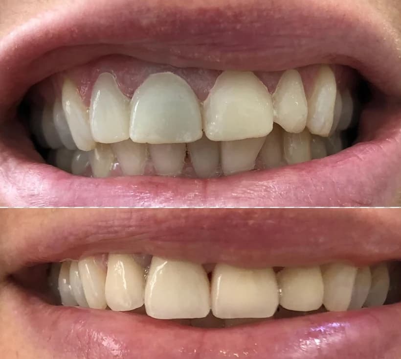 Smile makeover, frontal view of both arches. Upper half, before treatment: the teeth show irregular edges and shades that vary from one tooth to the next. Lower half, after treatment: shapes and shade are regular across the whole smile.