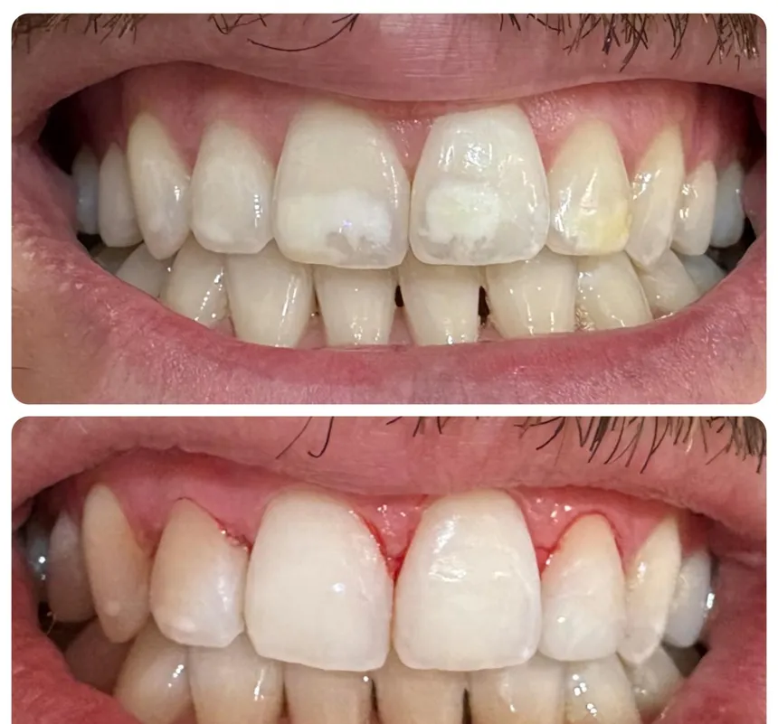 White spots on the maxillary incisors, frontal view of the smile with the teeth in contact. Upper half, before treatment: opaque white patches stand out on the enamel of the central and lateral incisors. Lower half, after treatment: the enamel looks more even and the patches stand out far less from the tooth.