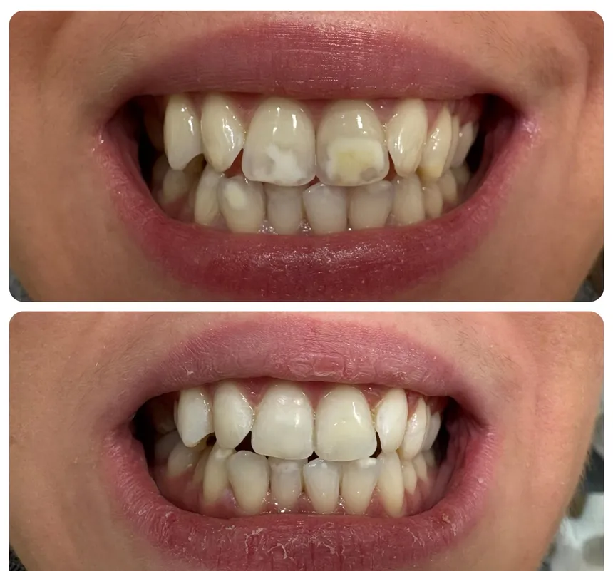 White spots on both arches, frontal view of the smile with the lips parted. Upper half, before treatment: broad white patches and a brownish area mark the maxillary central incisors, with smaller spots on the mandibular incisors. Lower half, after treatment: these marks stand out far less from the surrounding enamel.