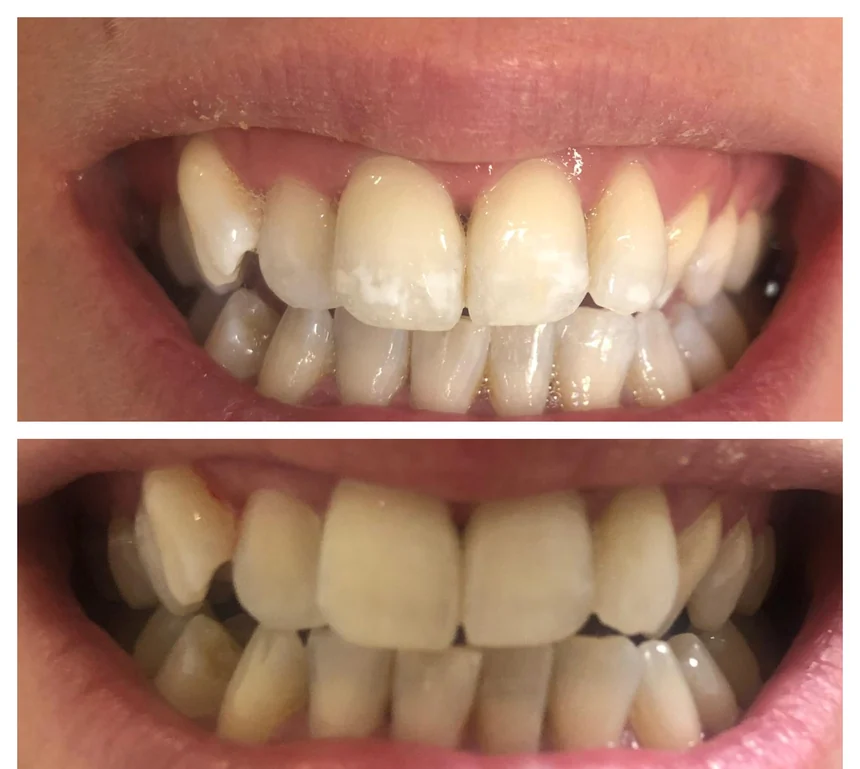 White spots on both arches, teeth in contact, frontal view of the smile. Upper half, before treatment: opaque white patches mark the maxillary incisors and canines. Lower half, after treatment: these patches stand out far less from the surrounding enamel.