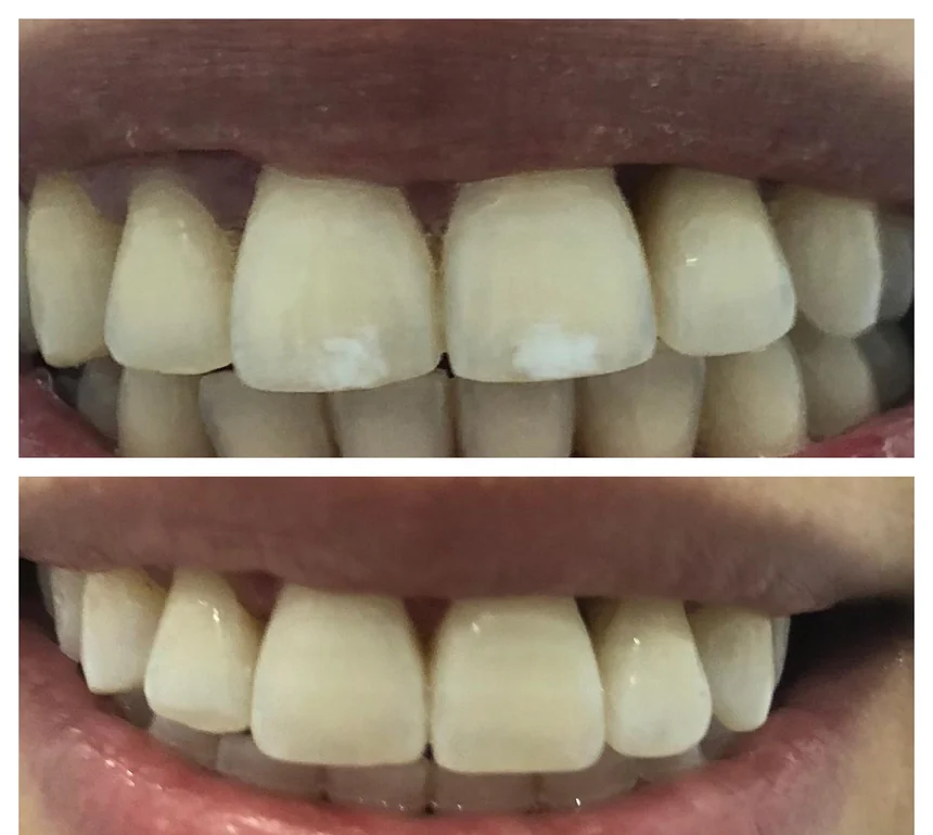 White spots on the anterior region, teeth in contact. Upper half, before treatment: a pronounced white patch covers one maxillary central incisor. Lower half, after treatment: the tooth shows a shade closer to that of its neighbours.