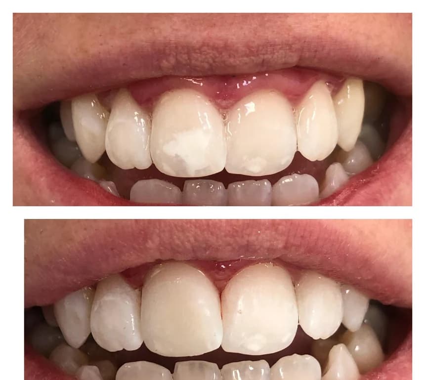 Taches blanches sur les incisives maxillaires, sourire de face. Moitié haute, avant traitement : des plages blanches opaques se détachent nettement sur les incisives centrales. Moitié basse, après traitement : le contraste entre ces plages et l’émail voisin est fortement réduit.